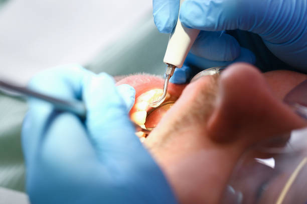 Best Emergency Tooth Extraction in Lake Of The Pines, CA