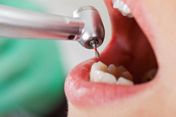 Best Emergency Dental Care for Broken or Chipped Teeth in Lake Of The Pines, CA
